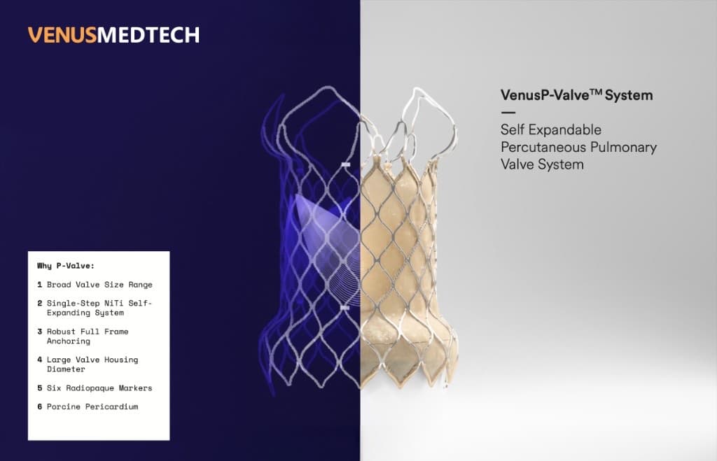 VenusP-Valve™